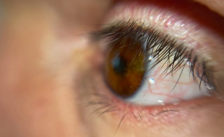 Patient receives the world’s first fully 3D-printed prosthetic eye