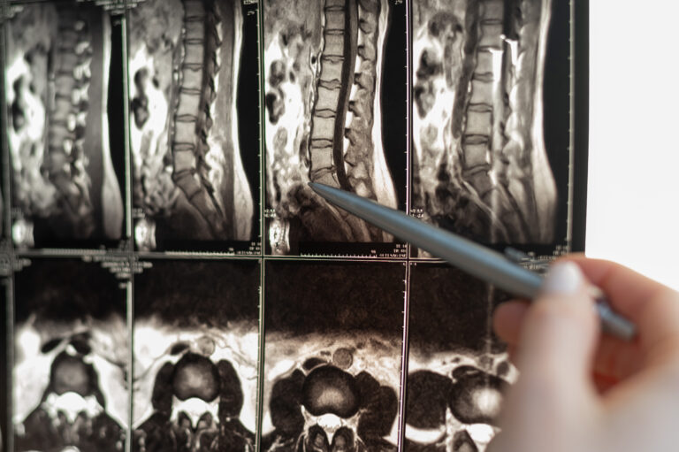AI discovery could advance the treatment of spinal cord injuries